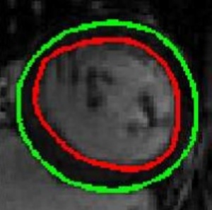 Semi-automated cardiac segmentation on cine magnetic resonance images using GVF-Snake deformable models