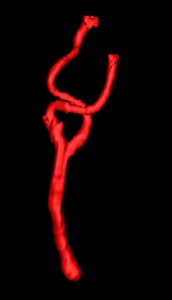 Implementation of graph-based interactive 3D vessel segmentation filter