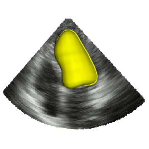 Learning Shape Representations for Multi-Atlas Endocardium Segmentation in 3D Echo Images