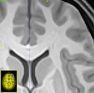 Two Luis Miguel fans walk into a bar in Nagoya ---> (yada, yada, yada) ---> an ITK-implementation of a popular patch-based denoising filter